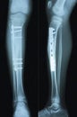 Film x-ray tibia Royalty Free Stock Photo